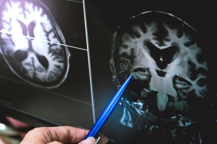 Scan of a brain.